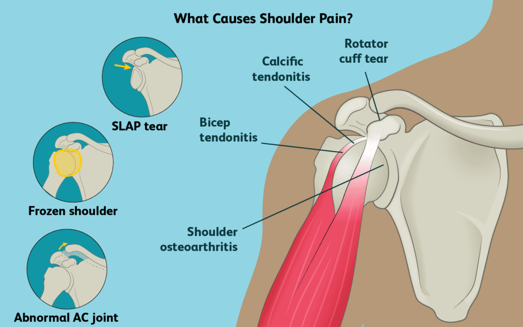 Person applying natural pain relief cream to their shoulder as part of Shoulder Pain Solutions to reduce inflammation and relieve shoulder pain.